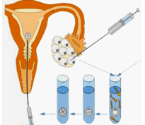 ГИФТ и ЗИФТ