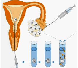 ГИФТ и ЗИФТ