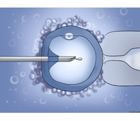 Процедура ИКСИ